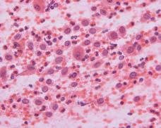 Figure 4 - Langerhans Cells