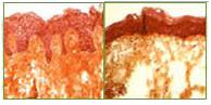 Figure 1 - A histological comparison of the skin. To the left is the histological section of a young person, while to the right is the histological section of the skin of an aged person.