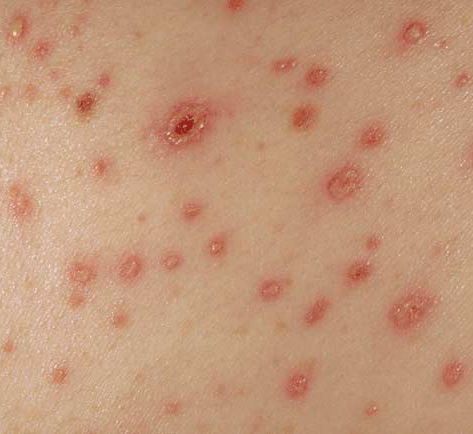 A picture of a common adverse drug reaction - the skin rash (reference 3)